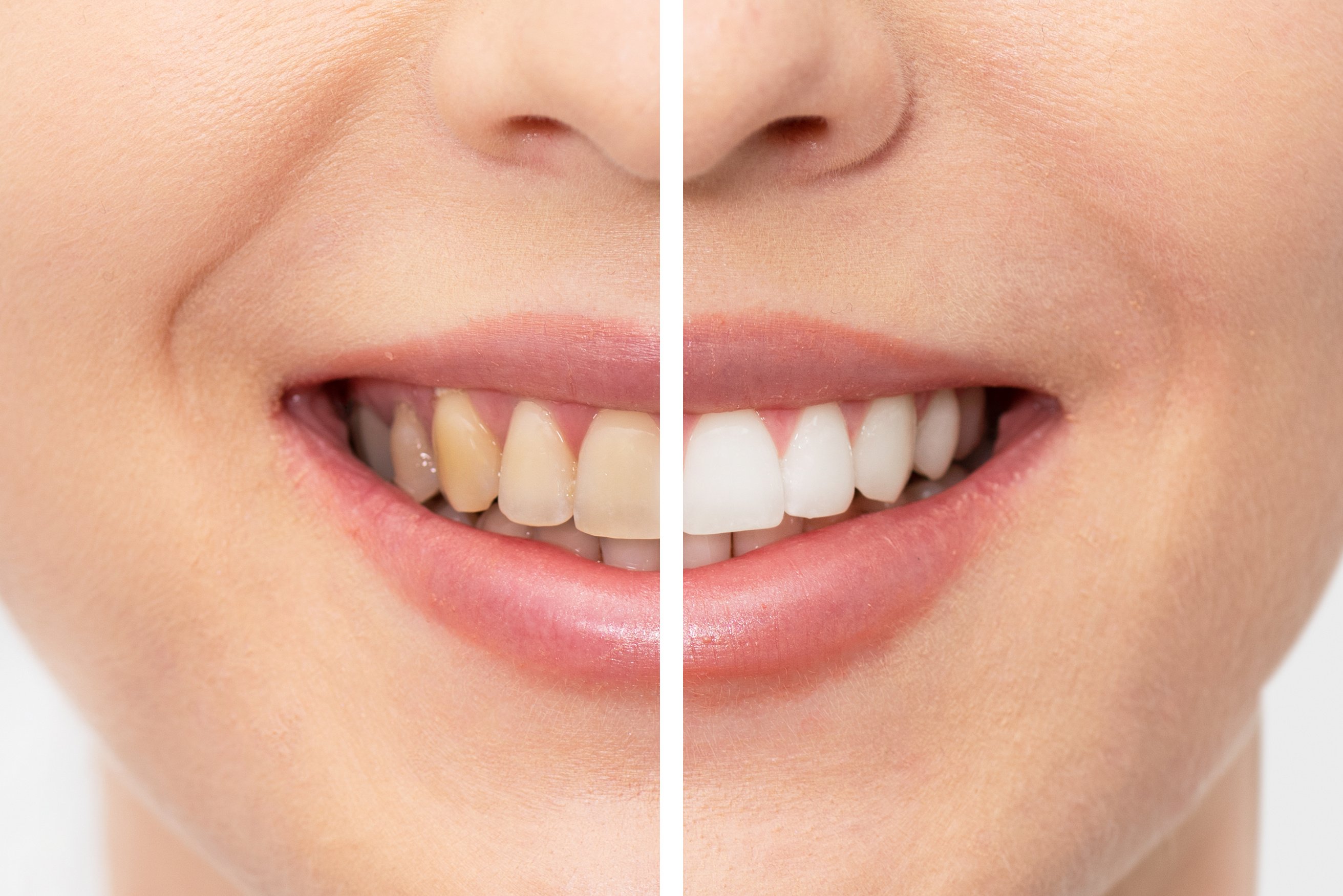 Teeth before and after whitening