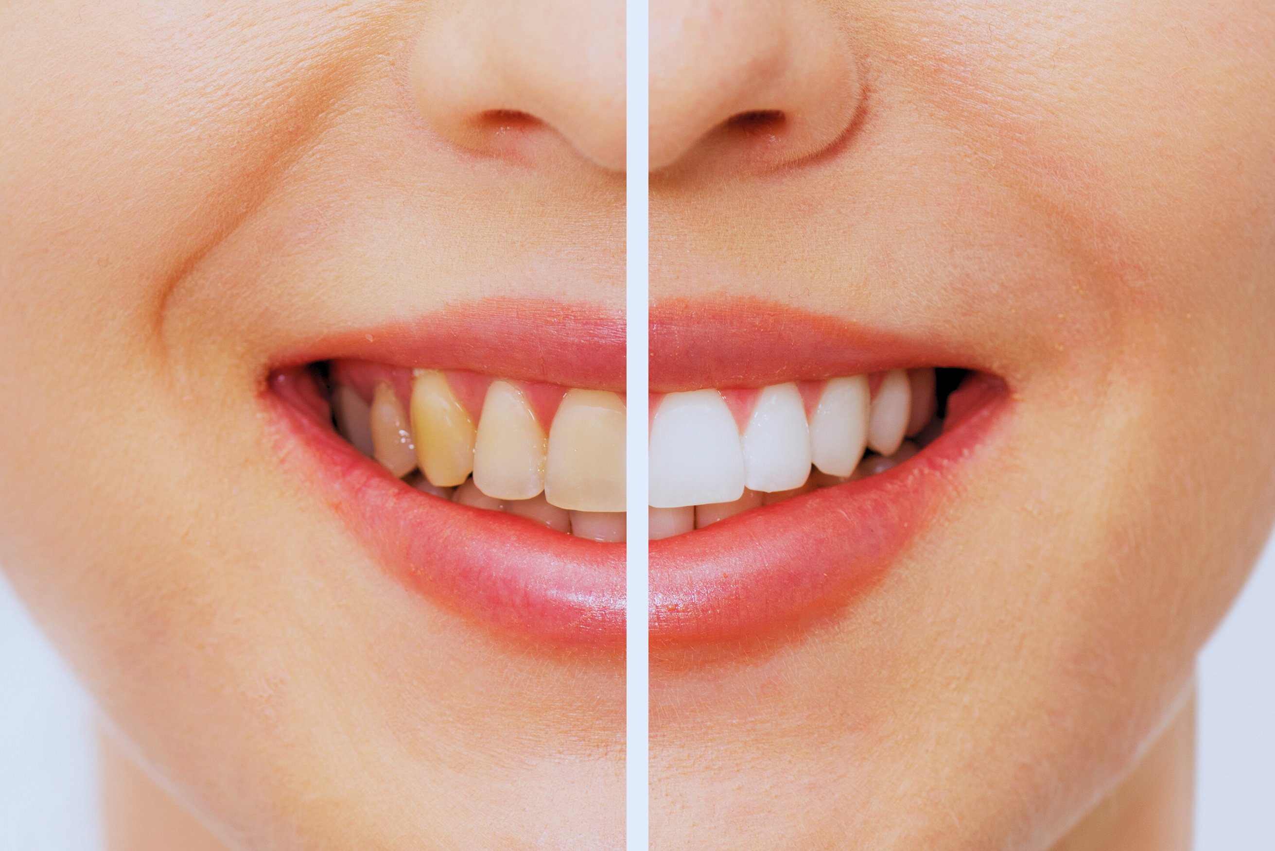 Teeth before and after whitening