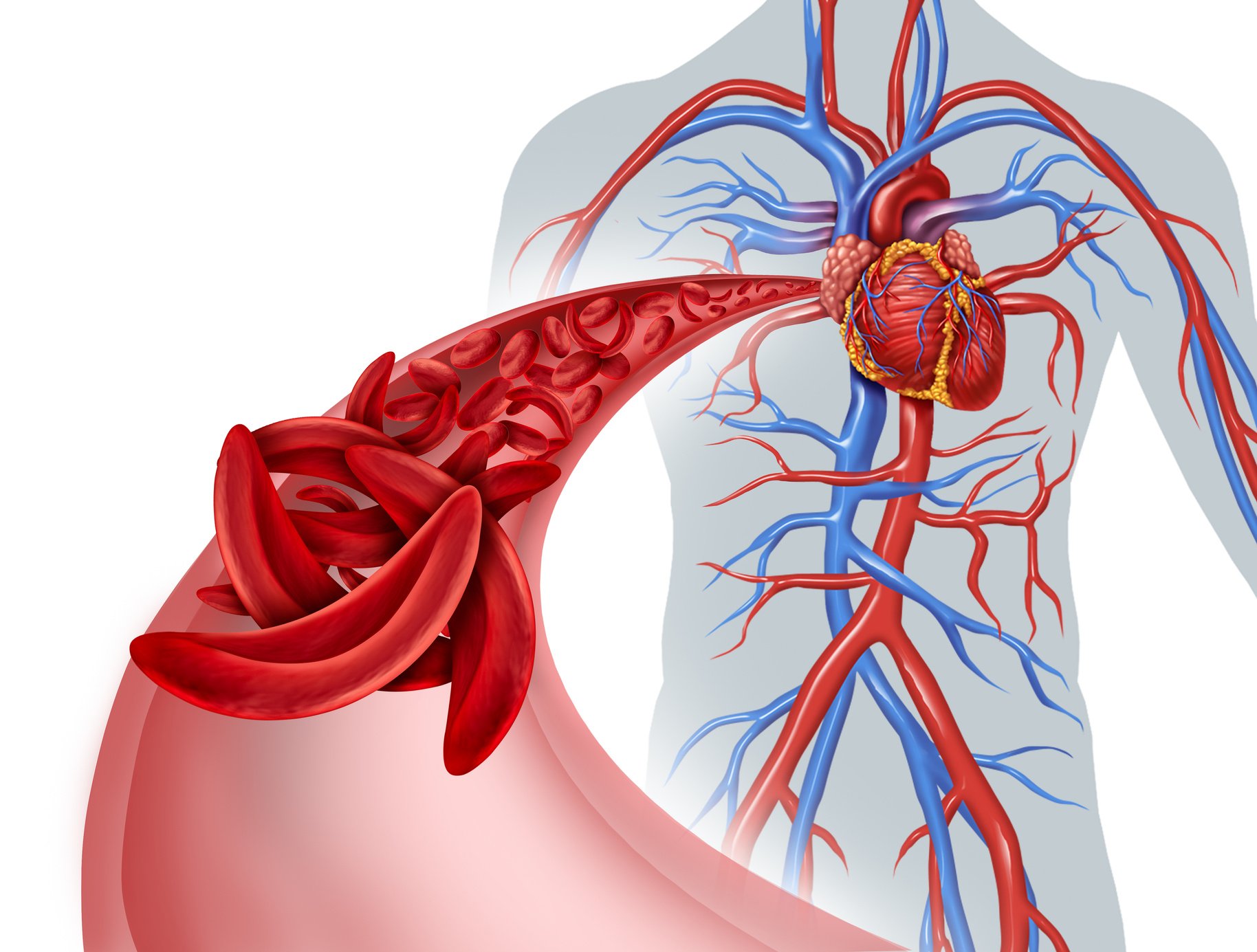 Sickle Cell Circulation Blockage